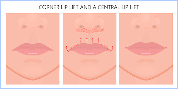 جراحی لیفت لب سانترال و لیفت لب گوشه
