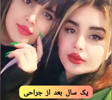 یک سال بعد از عمل بینی استخوانی به سبک طبیعی