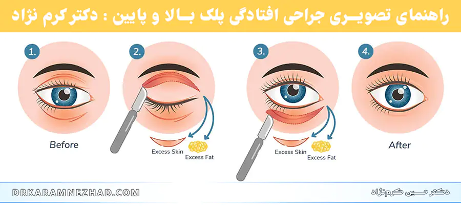 راهنمای روش جراحی بلفاروپلاستی و افتادگی پلک بالا و پایین