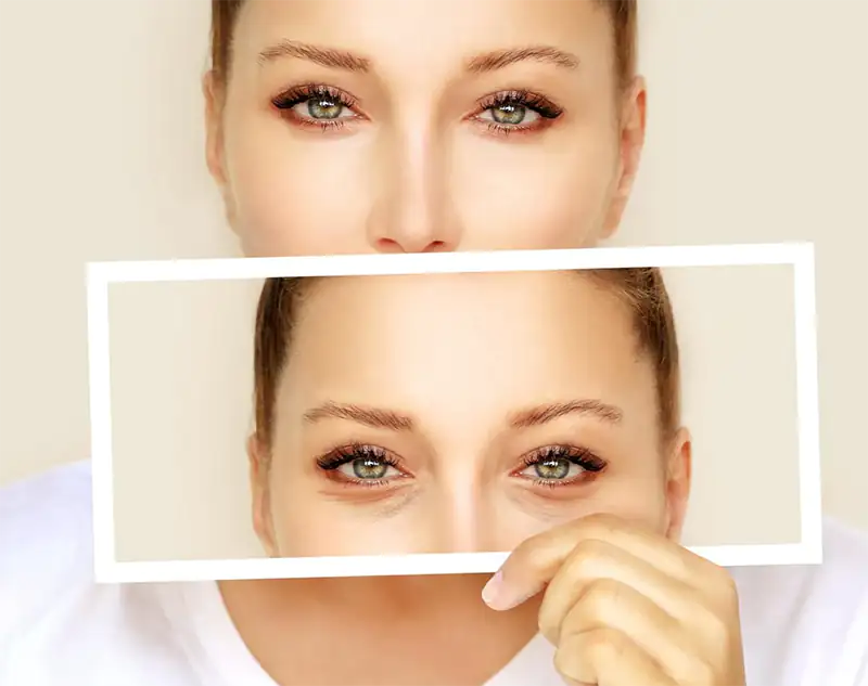 هزینه جراحی افتادگی پلک یا بلفاروپلاستی در شیراز