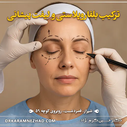 ترکیب بلفاروپلاستی و لیفت پیشانی 1 ترکیب بلفاروپلاستی و لیفت پیشانی