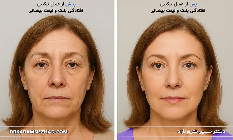 قبل و بعد عمل لیفت پیشانی و افتادگی پلک